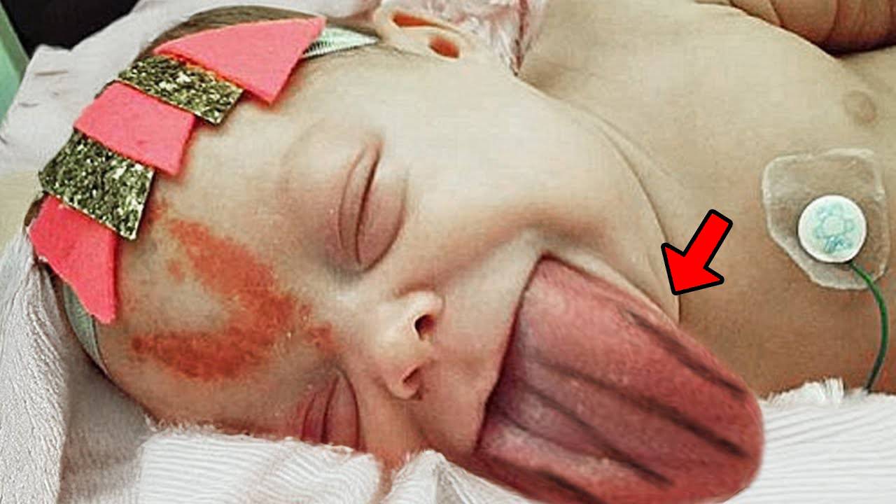 Помните девочку, родившуюся с большим языком? Вы не поверите, как она выглядит сейчас! смотреть онлайн