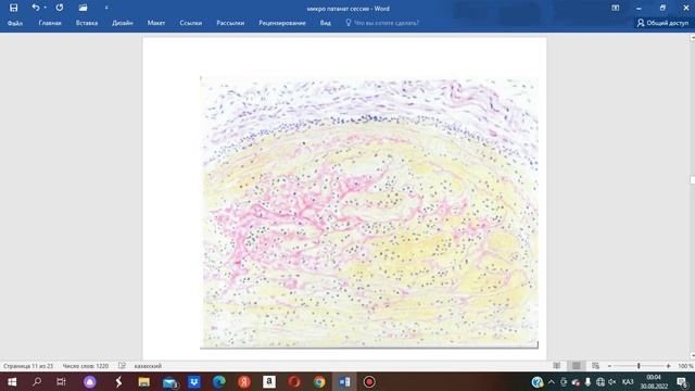 Аралас тромб - патологиялық анатомиясы. Patanatomy - in kazakh смотреть онлайн
