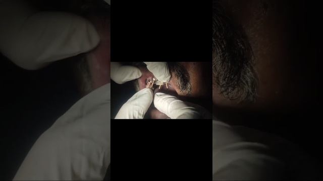 Root canal preparation of canals #dental #dentistry #smile #drabidahussain786@drabidahussain786 смотреть онлайн