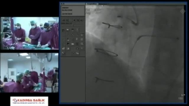 canlı olgu: kalsifik koroner darlık ve rotablator anjiyoplasti смотреть онлайн