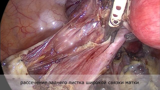 Операция по удалению (экстирпации) матки с маточными трубами смотреть онлайн