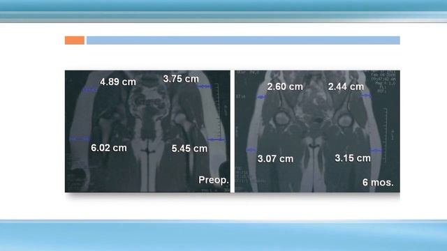 Body Contouring with Laser Liposuction, SmartLipo смотреть онлайн