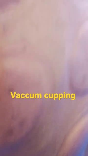 vaccum cupping therapy # cup therapy # shoulder pain # bodybuilding # body recovery # short # short смотреть онлайн