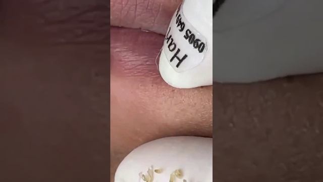 blackheads removal from the lips 💋, #blackheads #satisfying #foryou #pimple #fyp #acne #blackhead смотреть онлайн