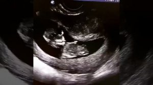 УЗИ малыша в сроке 12-13 недель (видео 1)
