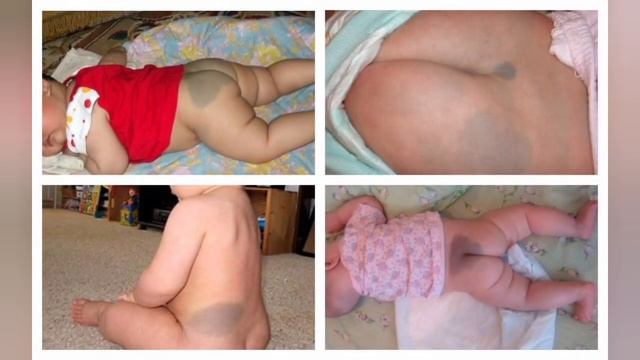 Bolalarda mongol dog'i | @pediatric_uz смотреть онлайн