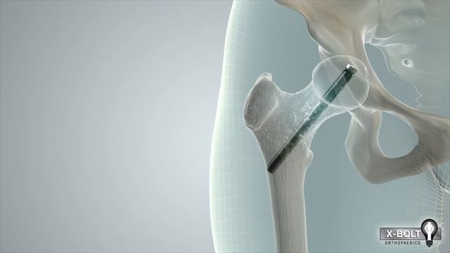 X-Bolt Plating Technique смотреть онлайн