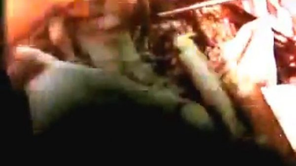 Резекционная трепанация черепа (учебный фильм из СССР)