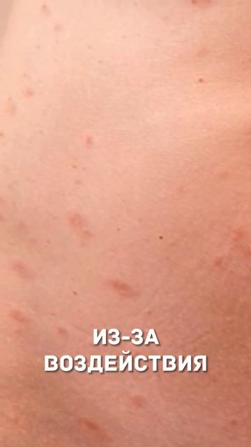 Причины розового лишая #shorts #health смотреть онлайн