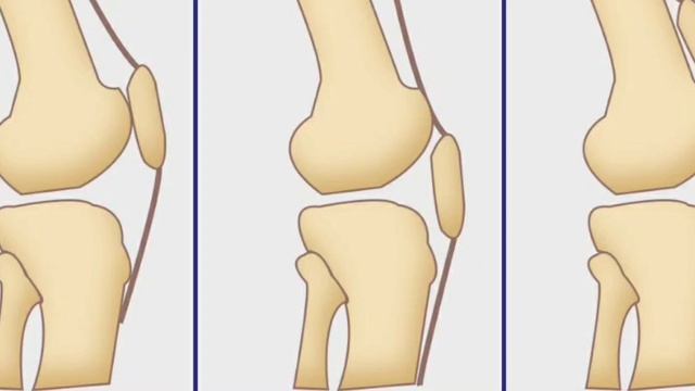 PATELA ALTA PART II смотреть онлайн