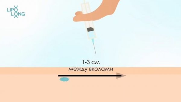 Как правильно вводить Lipo Long
