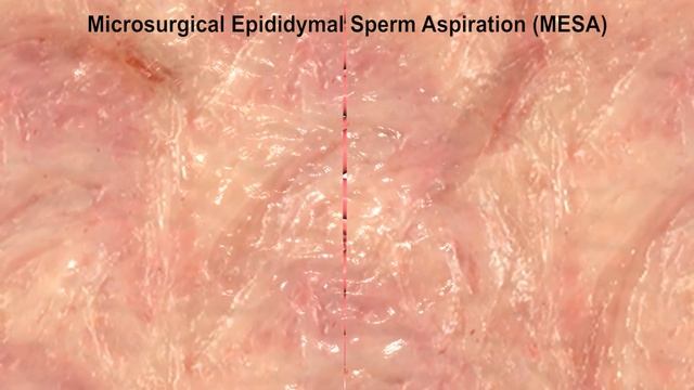 Best Andrology Gynaecology Infertility Centres || PESA, MESA, TESA, TESE, MAESA