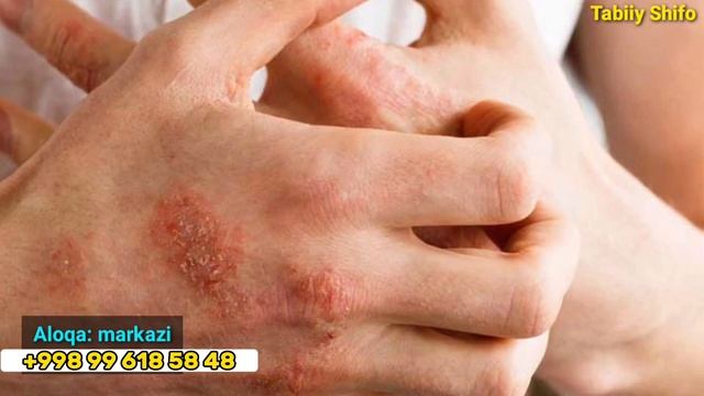 эшак еми касаллигини давоси тарвок касаллиг сабаблари ва Уни даволаш Tarmoqni uyda tabiiy davolash смотреть онлайн