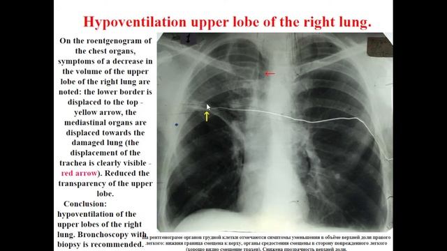 15:00-16:30 X ray diagnostic of tumors of lungs and mediastinum смотреть онлайн
