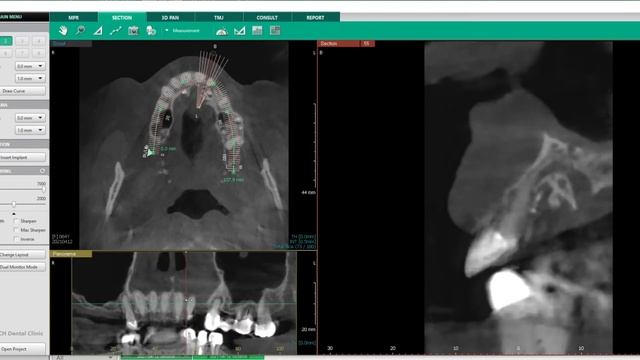 Uncovering the Real Cost of All-on-Four Implants: What You Need to Know Before You Decide смотреть онлайн