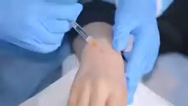 Dr. Gabriel Siquier is performing hand rejuvenation with Apriline® смотреть онлайн