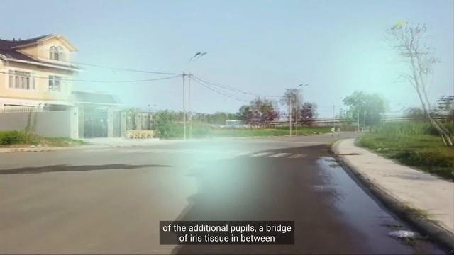 Unbelievable Eye Condition Exposed: The Rare Phenomenon Of Two Pupils In One Eye!