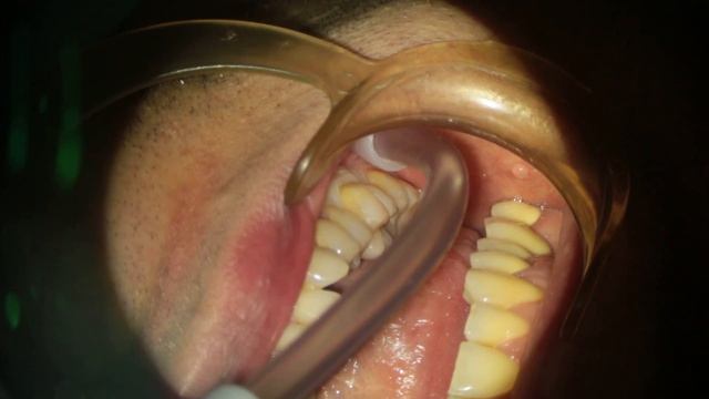 Интрасептальная анестезия. смотреть онлайн