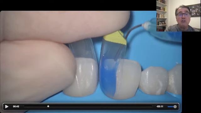 Caso Clínico 3: Fechamento de Diastema com Matriz BT Bioclear смотреть онлайн