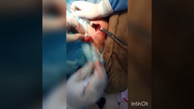 Операція. Осифікуючий бурсит плечового суглоба. Bursitis calcareas. Оссифицирующий бурсит. смотреть онлайн