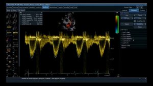 УЗИ аппарат GE Vivid E90
