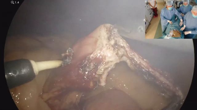 Cosmetic modification of OAGB with a very short limb смотреть онлайн