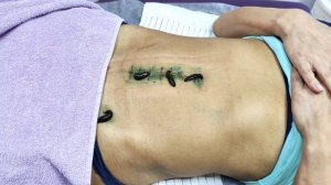 Убираем рубцы, спайки и шрамы после операции!