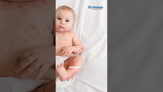 Bolalarda Qizamiq Kasalligi | Doctor Hasan Medical Center