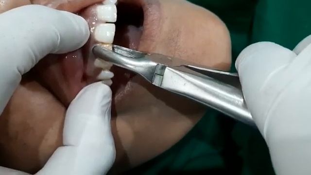 Tooth Extration смотреть онлайн