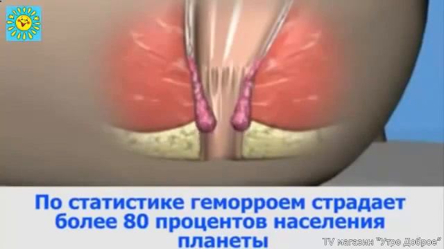 крем против геморроя смотреть онлайн