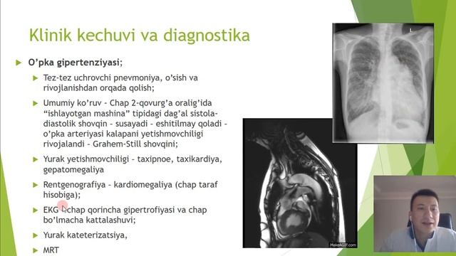 Tug'ma yurak nuqsoni (YTN, ВПС). Ochiq arterial yo'lak (OAY, ОАП). Bobur Turaev. ToshPMI klinikasi смотреть онлайн
