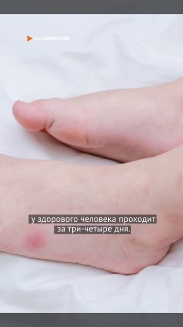 Укус этого насекомого будет заживать месяц! смотреть онлайн
