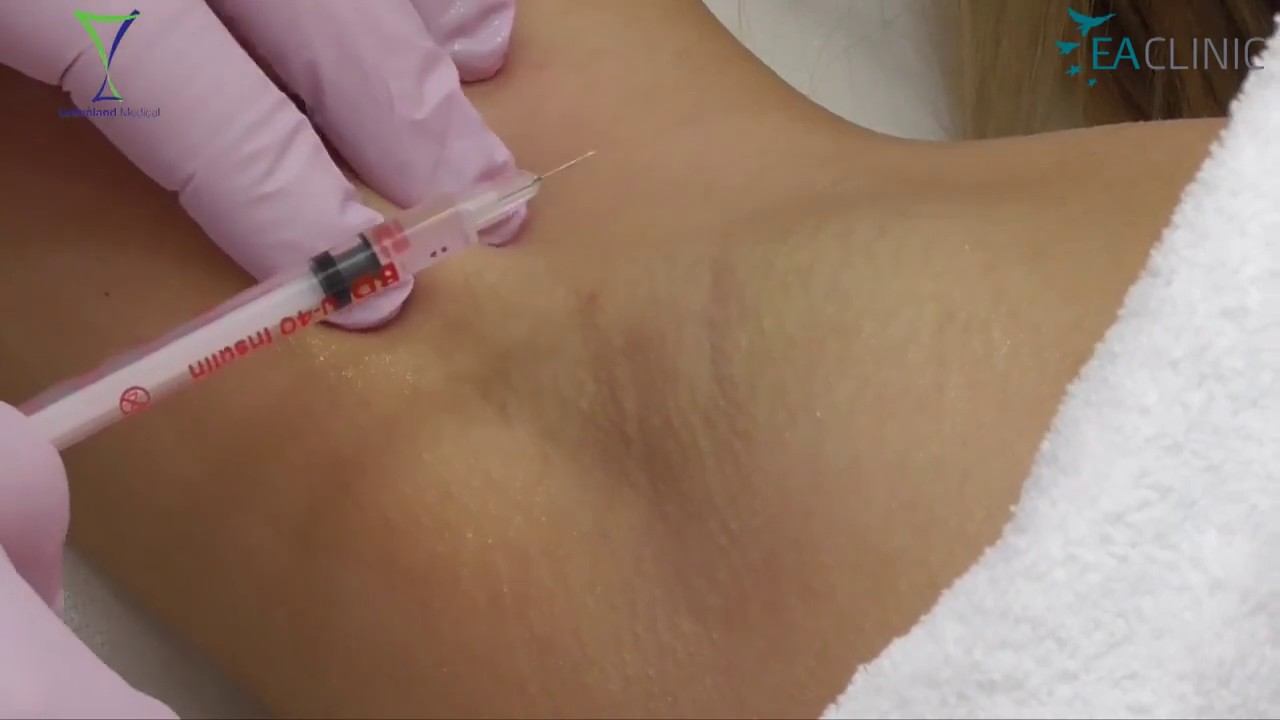 Удаление папиллом на радиоволновом аппарате Greenland Medical RFS 3800K