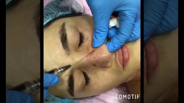 Контурная коррекция носа в Махачкале техника канюлей www klinikakda ru смотреть онлайн