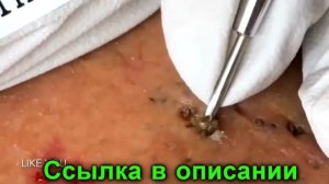 НОВОЕ! Чистка лица от черных точек  Удаление и выдавливание чёрных точек  Прыщи   выдавливание!