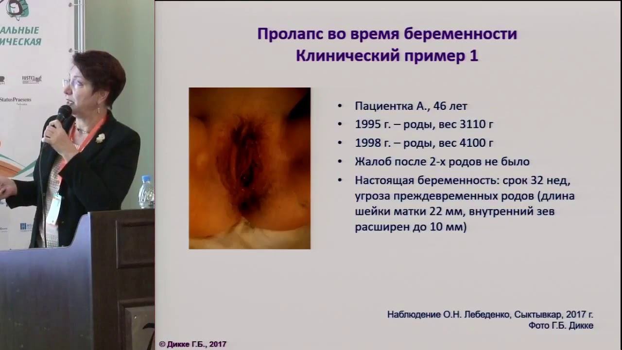 Задняя пластика влагалища, леваторопластика, пластика промежности. Контурная пластика смотреть онлайн