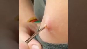 Удаление личинки овода из руки.