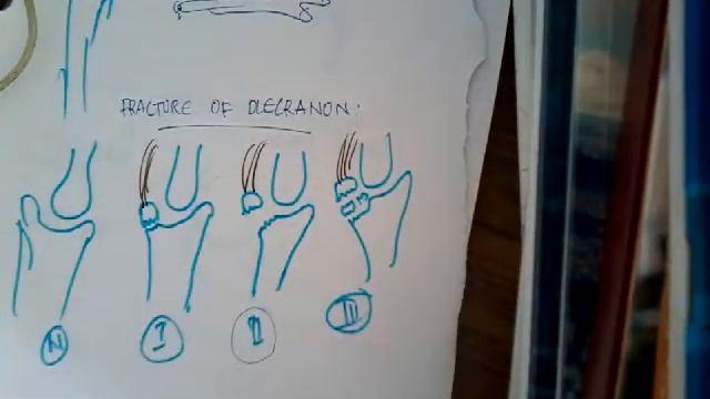 Fracture of olecranon || Orthopedics смотреть онлайн