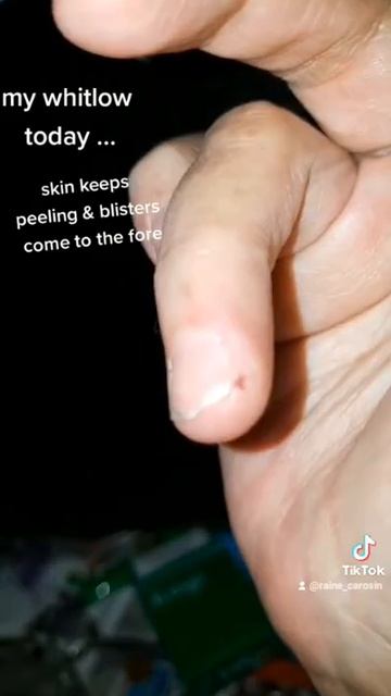 My continued Whitlow infection today смотреть онлайн