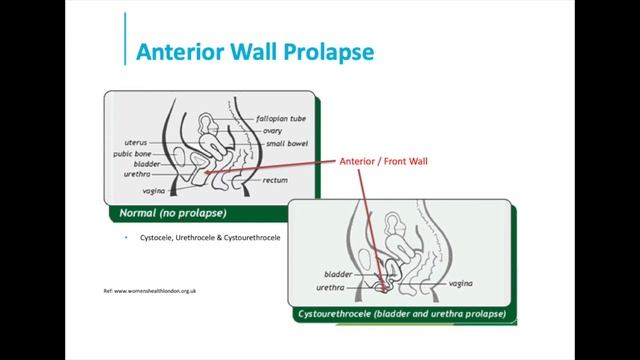 Pelvic Organ Prolapse смотреть онлайн