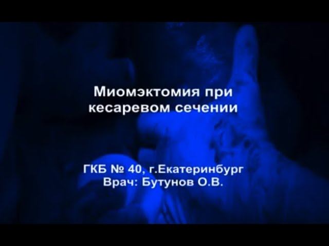 Миомэктомия при кесаревом сечении