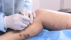 Минифлебэктомия. Удаление варикозных вен