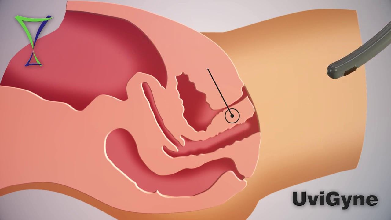 Радиоволновой RF лифтинг влагалища  эффективная процедура омоложения в гинекологии