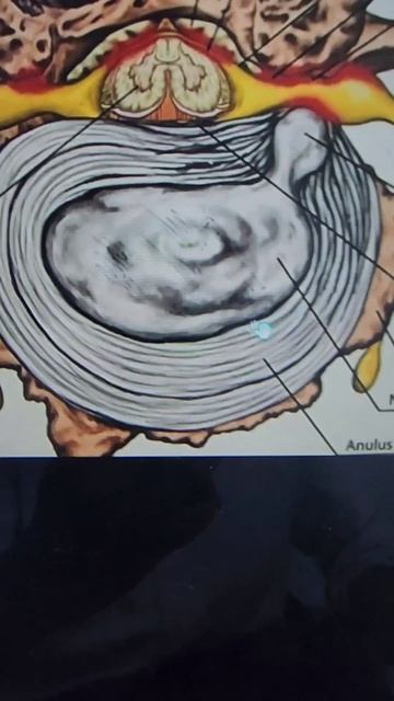 CHALLA,,The InterVertebral Disc смотреть онлайн