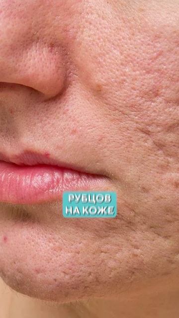 Мазь, которая УБЬЕТ кожу лица! #чистаякожа #косметика #морщины смотреть онлайн