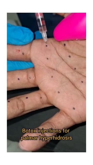 Botox injections for Palmar hyperhidrosis. book an appointment visit www.drsahitya.com #rajahmundr смотреть онлайн