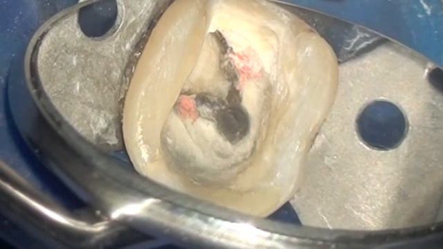 Fiberglass post remove смотреть онлайн