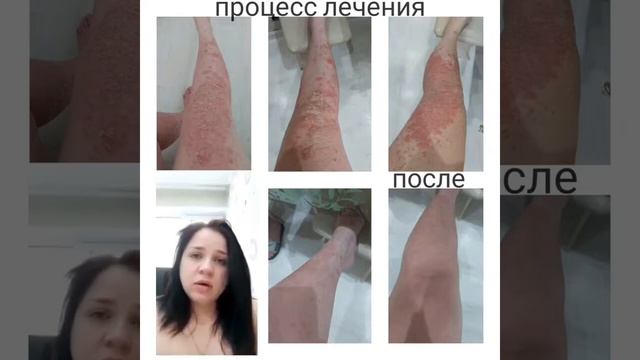 Результат с продукцией LR. Как справиться с ПСОРИАЗом. смотреть онлайн