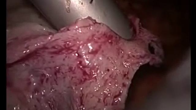 Морцеллятор в работе смотреть онлайн