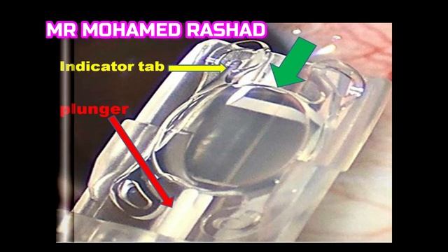 Akreos Adapt-AO Intraocular Lens IOL Implantation During Cataract Surgery زراعة عدسة العين